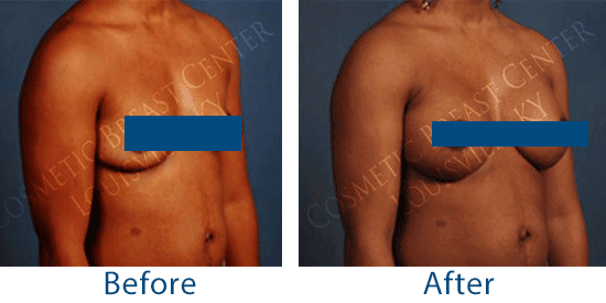 See before-and-after pictures of breast augmentation patients in Louisville, KY, who received a natural-looking result with silicone implants. 