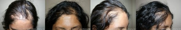 More before-and-after images of female NeoGraft patients.